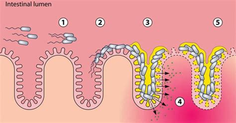 enteroaggregative e coli treatment