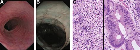 eosinophilic esophagitis barrett's esophagus