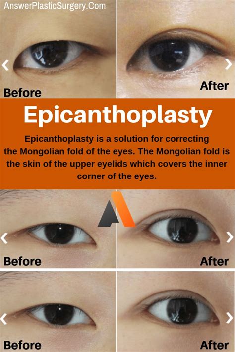 epicanthal fold surgery cost