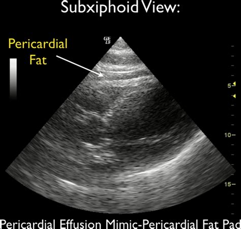 epicardial fat pad ultrasound