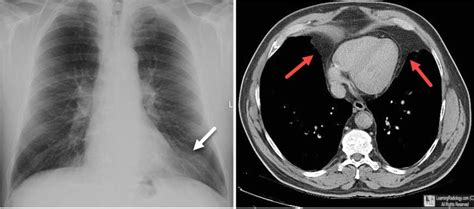 epicardial fat pad x ray