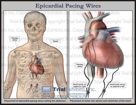 epicardial pacing wires after cardiac surgery