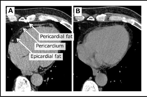 epicardial vs pericardial fat pad