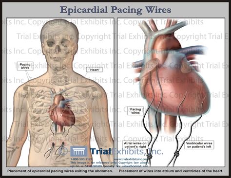 epicardial wires