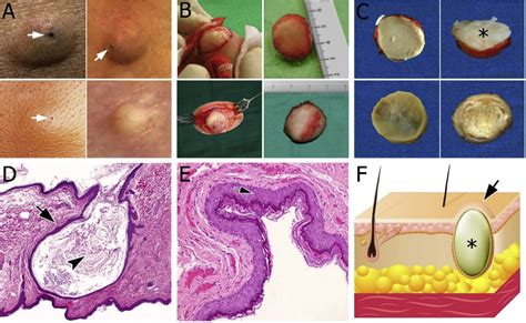 epidermoid cyst and sebaceous cyst