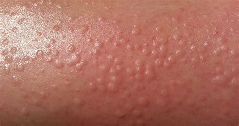 Epilator Bumps