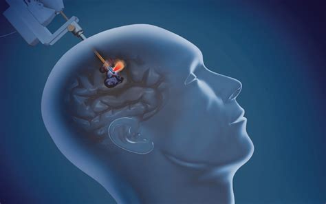epilepsy laser surgery procedure