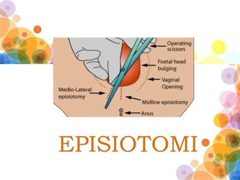 Episiotomi
