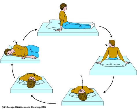 epley maneuver at home