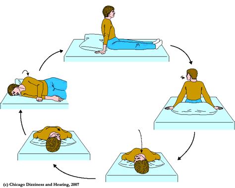 epley maneuver at home video