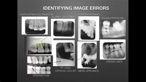 Errors In Radiography