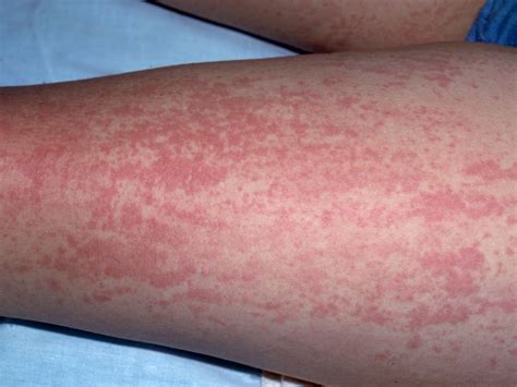 erythematous rash