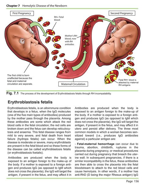 erythroblastosis fetalis