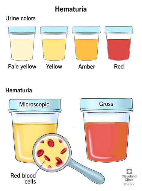 erythrocytes in urine meaning