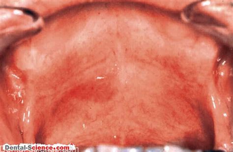 erythroplakia oral