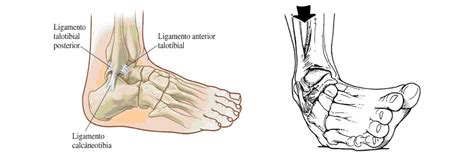 esguince ligamento lateral externo tobillo