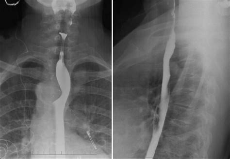 Barium swallow shows smooth external indentation on the esophagus from