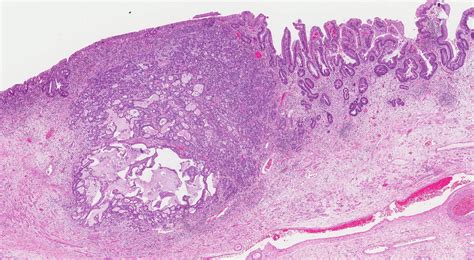 esophageal adenocarcinoma histology