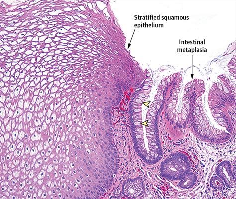 esophageal adenocarcinoma histology labeled