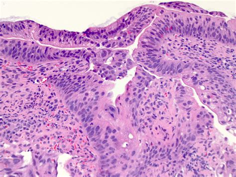 esophageal adenocarcinoma pathology outlines
