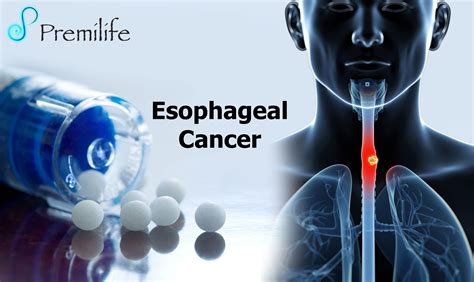 esophageal cancer patient assistance