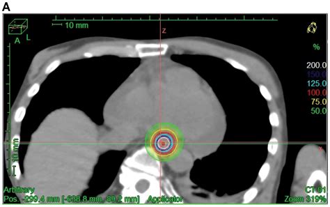 esophageal cancer radiation palliation