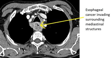 esophageal cancer staging ct