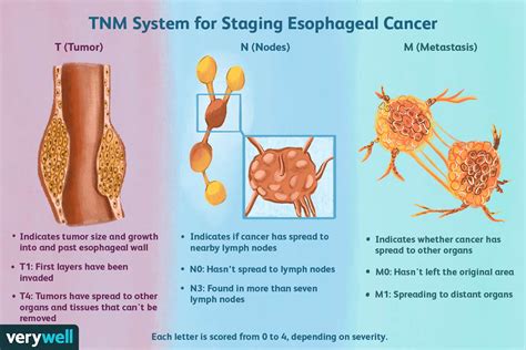 esophageal cancer staging t2n0