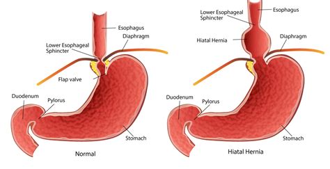 esophageal hiatal hernia