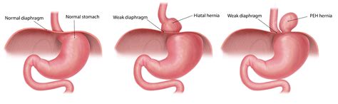 esophageal hiatal hernia icd 10