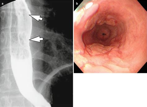 esophageal inflammation icd 10