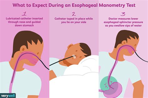 Understanding Esophageal Manometry Test: What to Expect from This Diagnostic Procedure