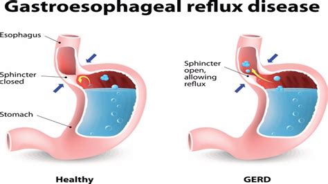 esophageal reflux disease with esophagitis