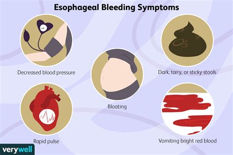 esophageal varices bleeding signs