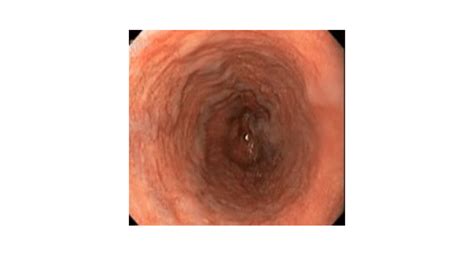 esophageal varices determined by endoscopy