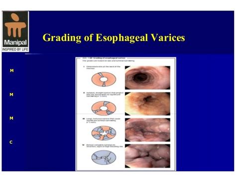 esophageal varices grading endoscopy