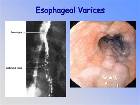 esophageal varices icd