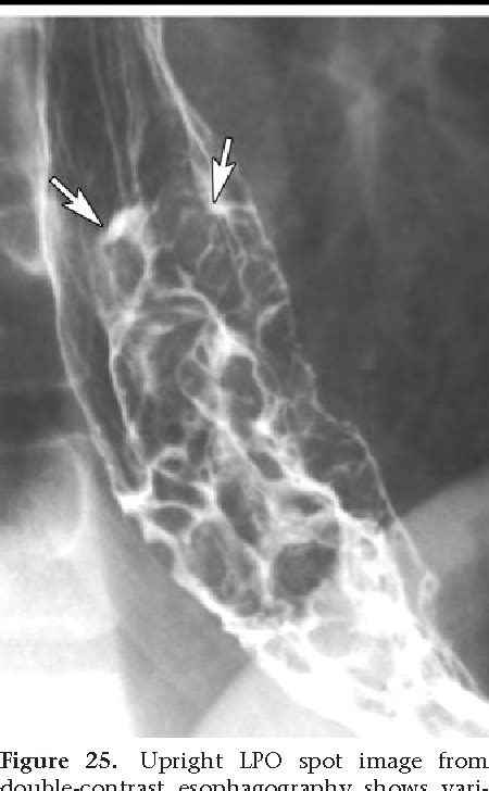 esophageal varices on esophagram