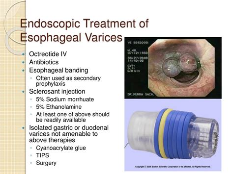 esophageal varices rupture treatment