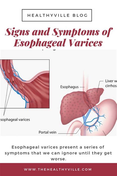 esophageal varices signs and symptoms