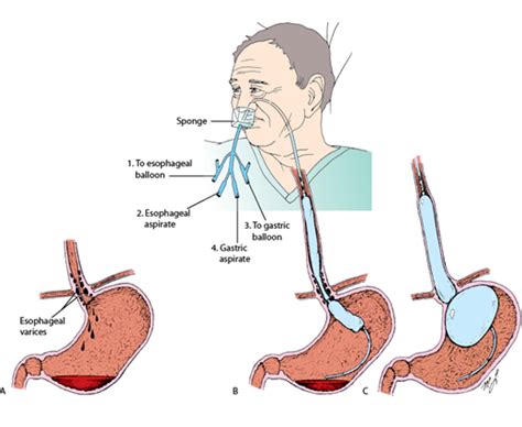 esophageal varices treatment emt