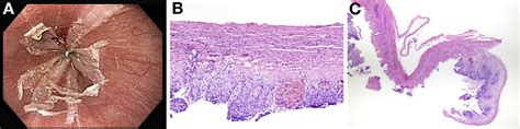 esophagitis dissecans superficialis causes