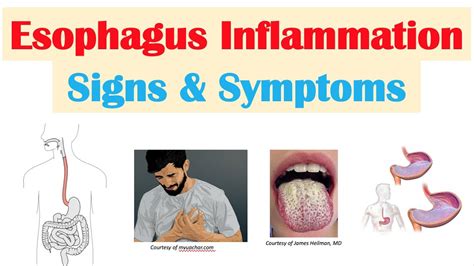 esophagitis pain in back