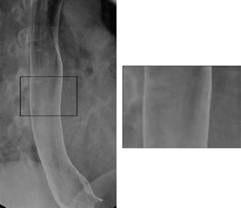 esophagram with double contrast