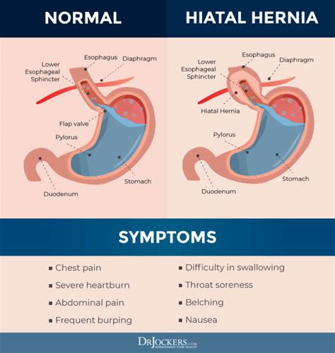 esophagus hernia in women