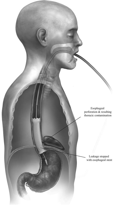 esophagus surgery for blockage