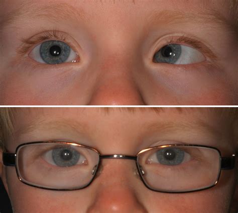 esotropia is a disorder