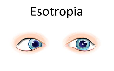 esotropia pronunciation
