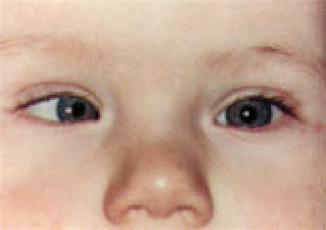 esotropia right eye