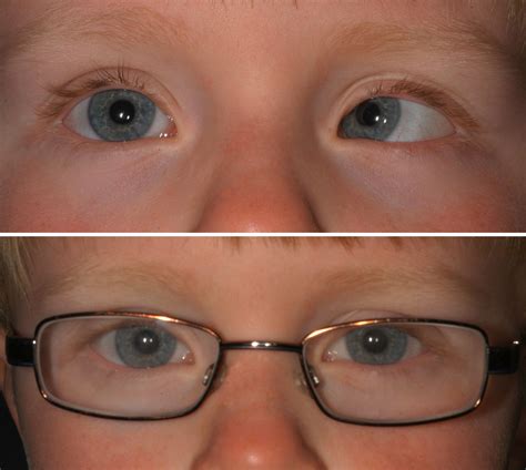 esotropia strabismus amblyopia